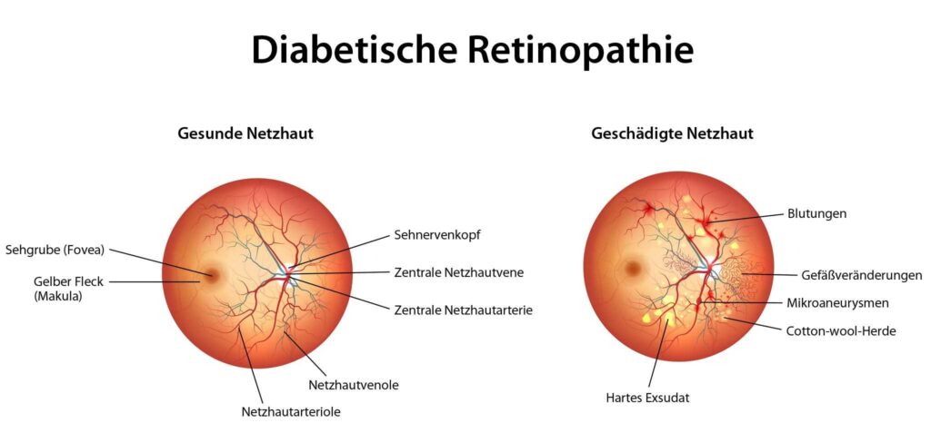 Schaubild zur diabetischen Retinopathie mit geschädigten Netzhautgefäßen
